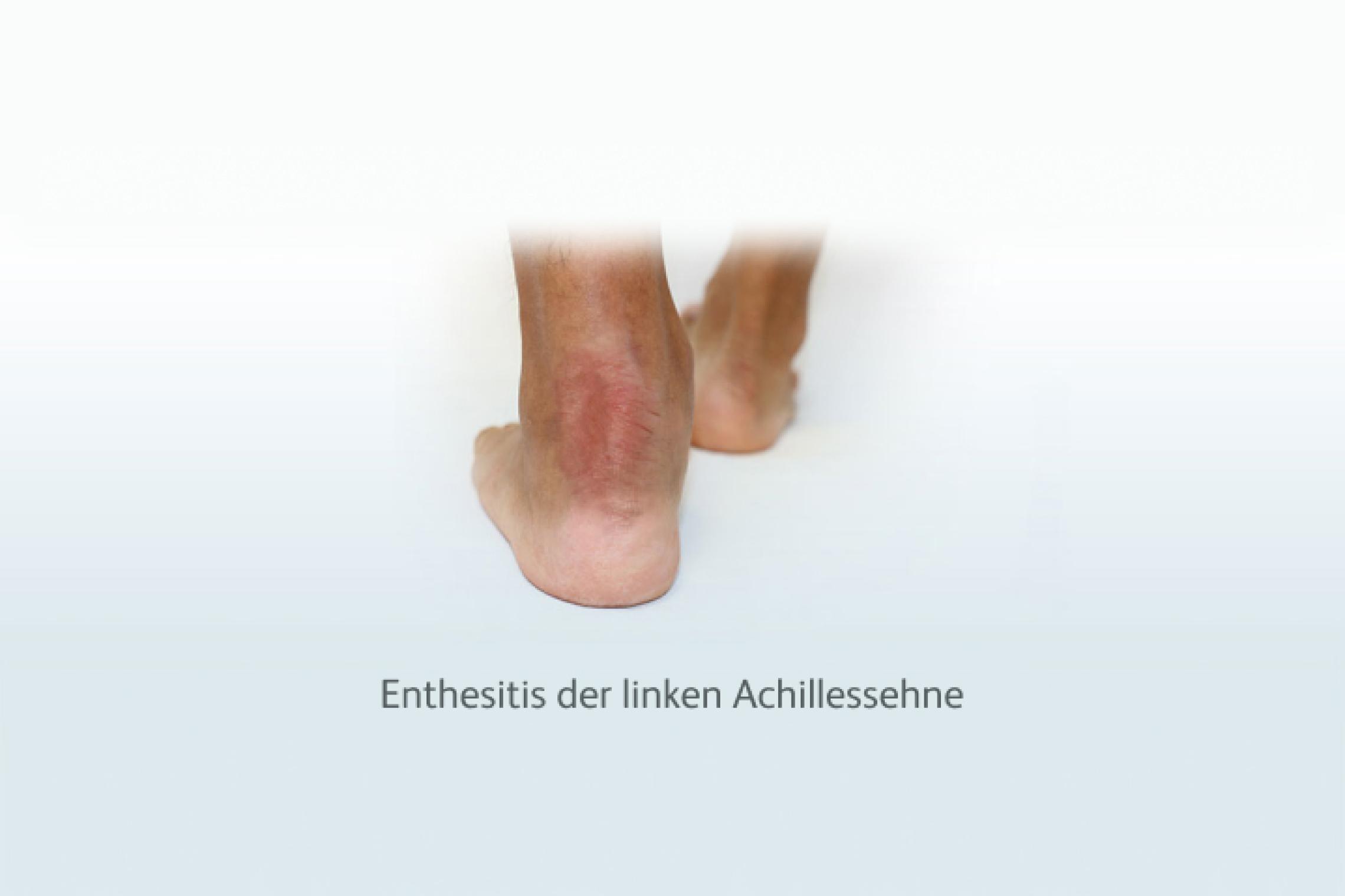 Enthesitis der linken Achillessehne