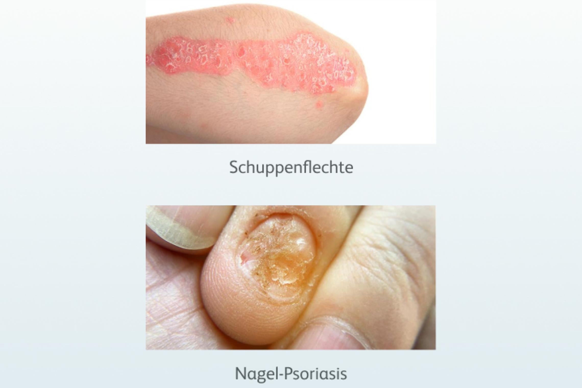 Schuppenflechte und Nagel-Psoriasis