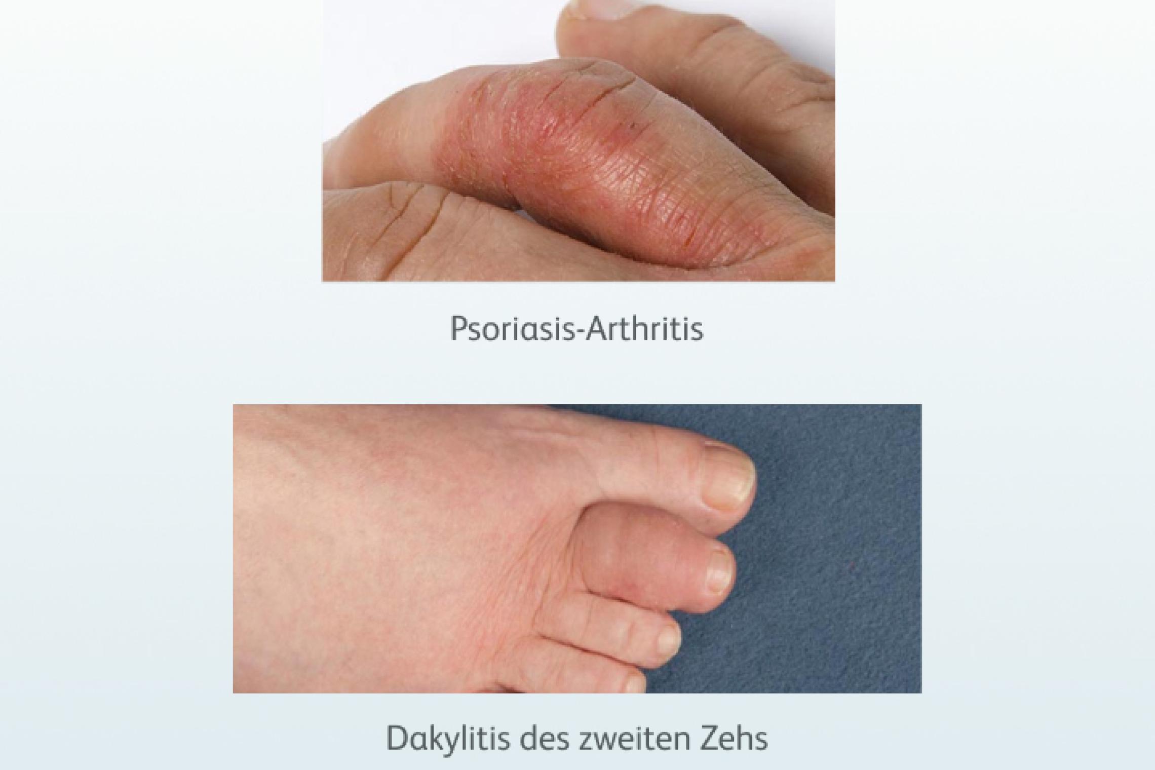 Psoriasis-Arthritis und Dakylitis des zweiten Zehns