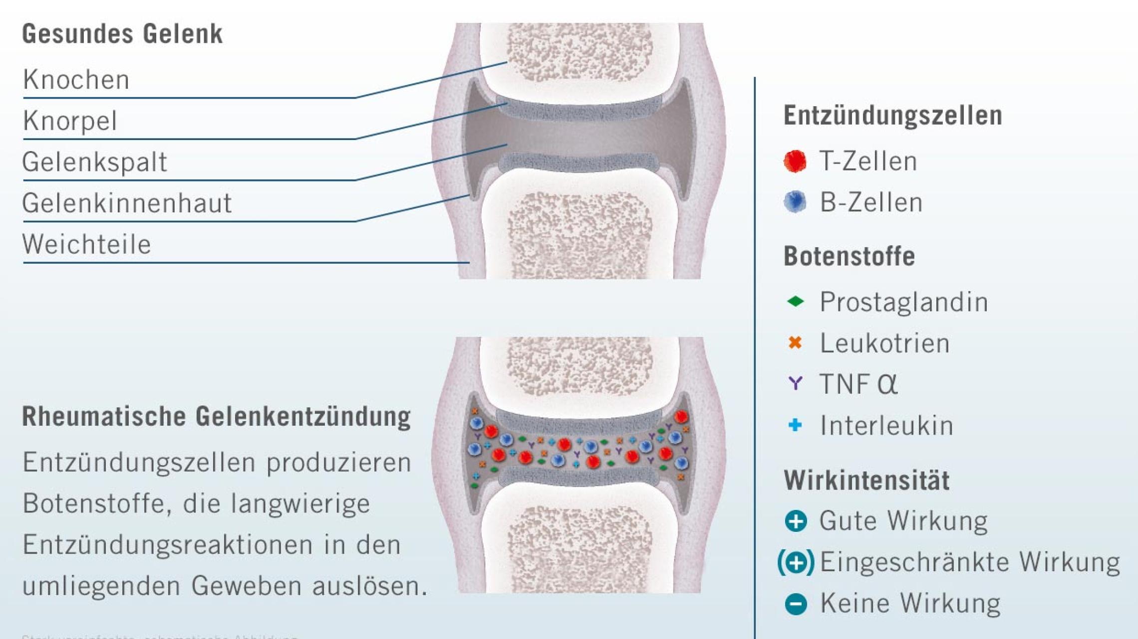 PsA Darstellung Gelenkentzündung