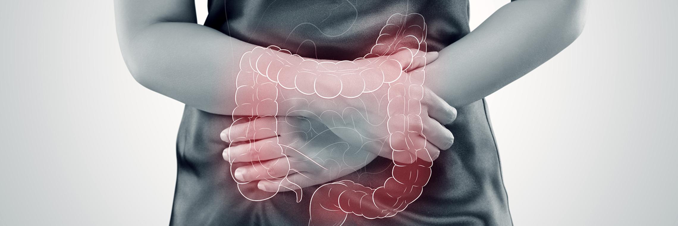 Typisch für Colitis ulcerosa ist ein entzündeter Dickdarm, der u. a. Diarrhöen mit Bauchschmerzen verursacht.