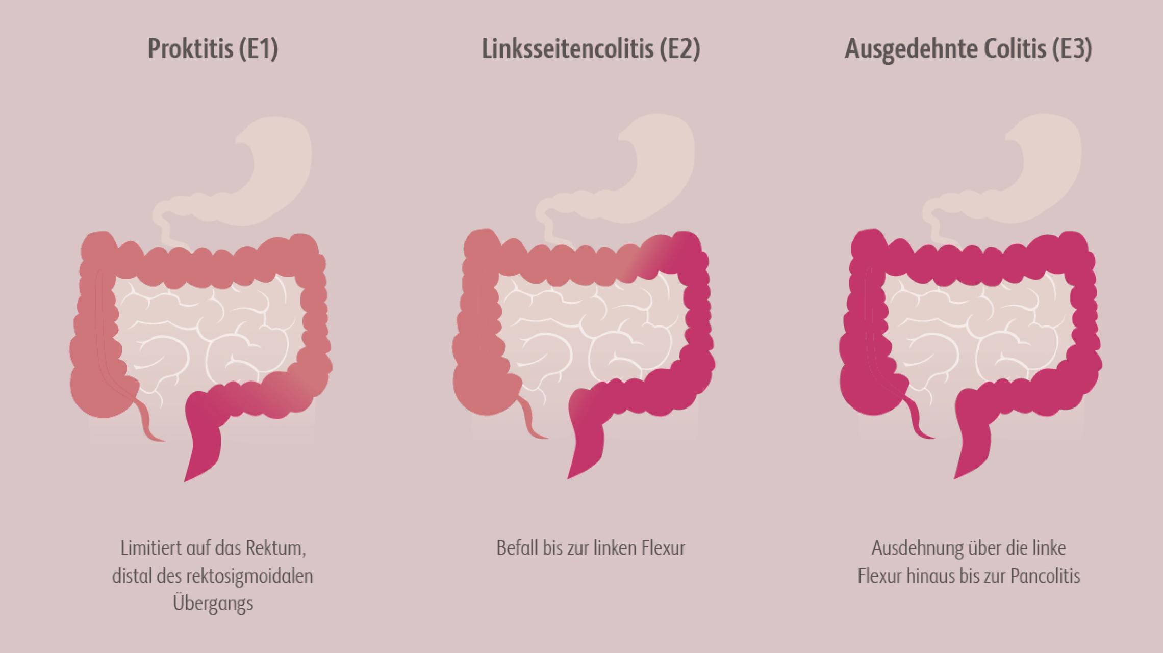 Ausdehnung der Colitis ulcerosa – Klassifikation nach Silverberg et al.: Proktitis, Linksseitencolitis, ausgedehnte Colitis