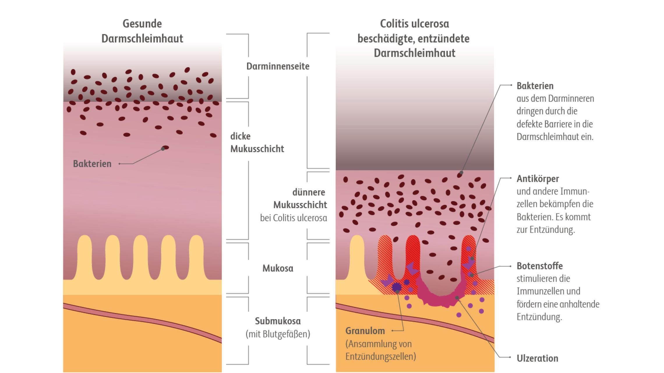 Entzündete Dickdarmschleimhaut bei Colitis Ulcerosa im Vergleich zu gesunder Dickdarmschleimhaut.