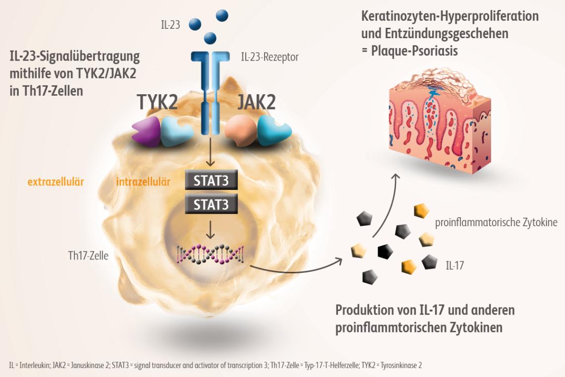 Bei der Pathogenese der Plaque-Psoriasis spielt die IL-23/Th17-Achse eine zentrale Rolle.