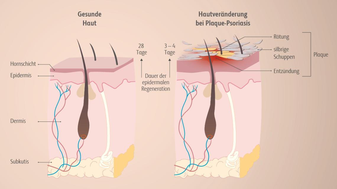 Bei Plaque-Psoriasis kommt es an den betroffenen Hautarealen zu einer abnormalen Differenzierung und Hyperproliferation der Keratinozyten, Schuppung, Entzündung und Rötung.