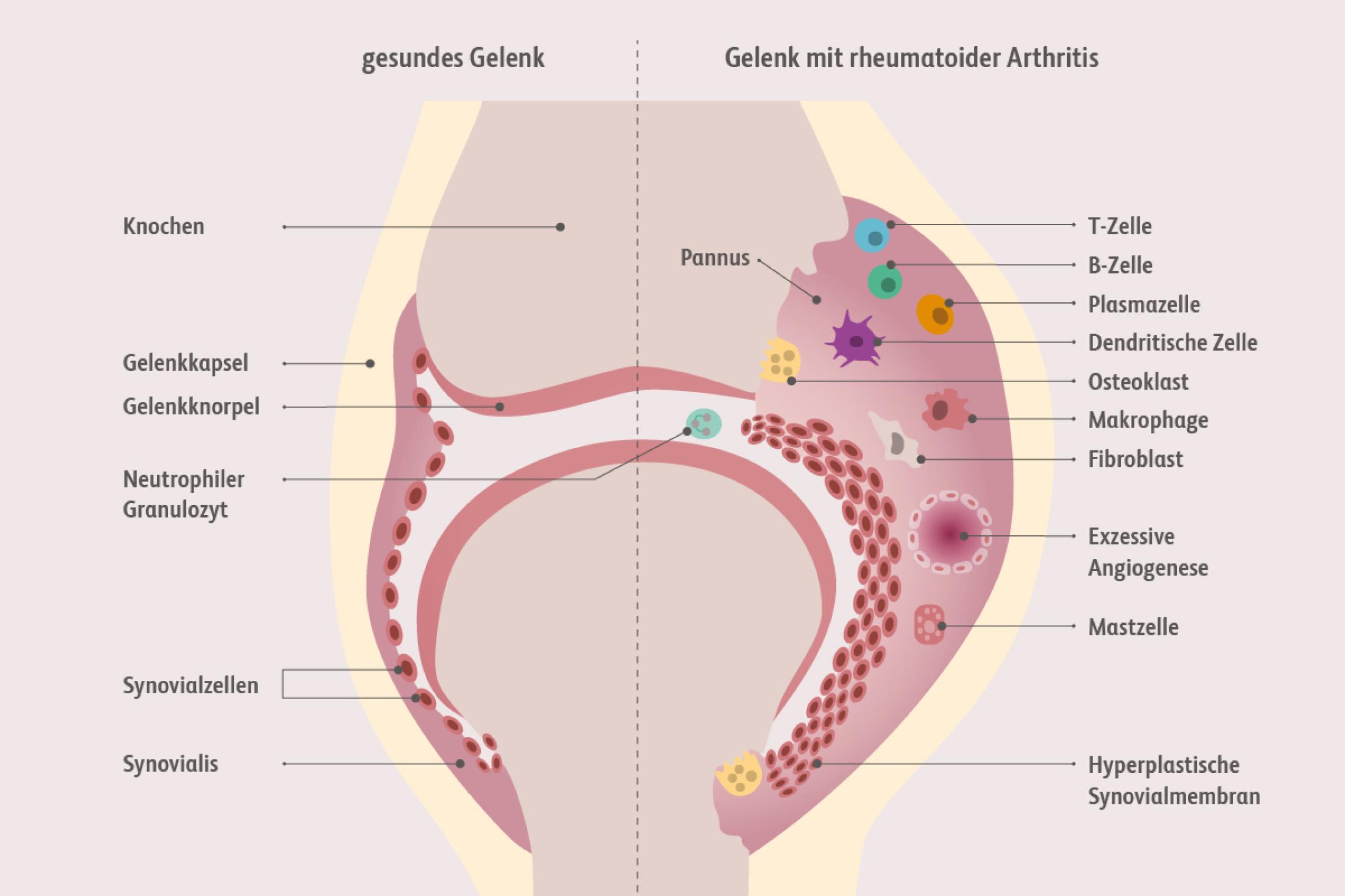 Die Pathogenese der rheumatoiden Arthritis ist gekennzeichnet durch Gefäßneubildung, Einstrom mononukleärer Zellen, Pannusbildung und Knochendestruktion.